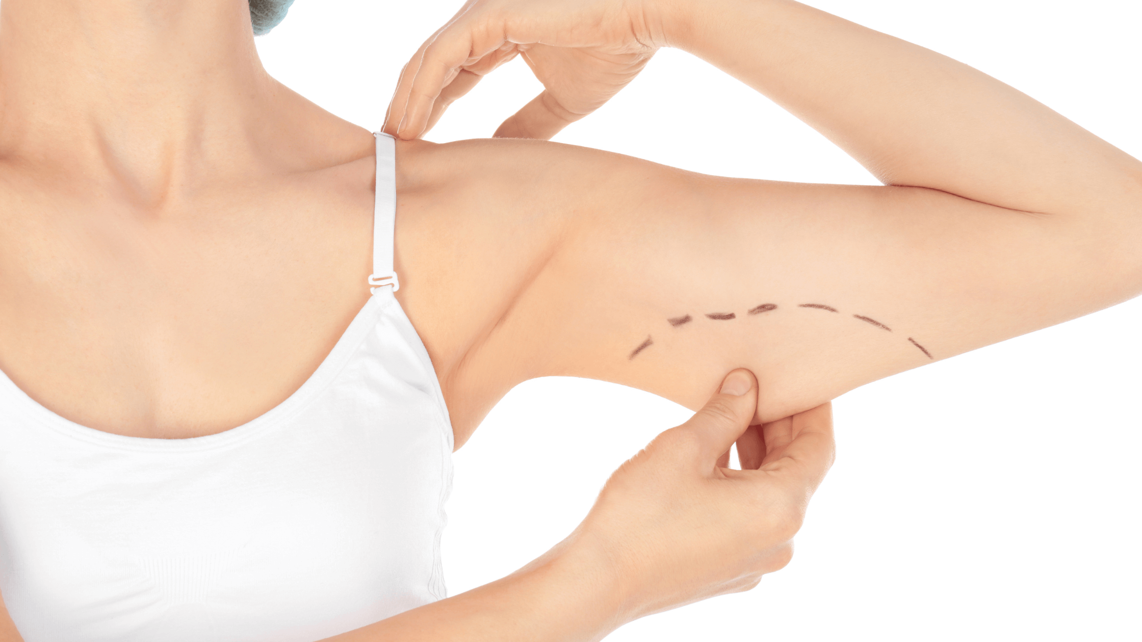 Preparing Mentally and Physically for Brachioplasty