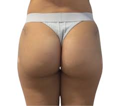 Brazilian Butt Lift: How Long Do Results Last