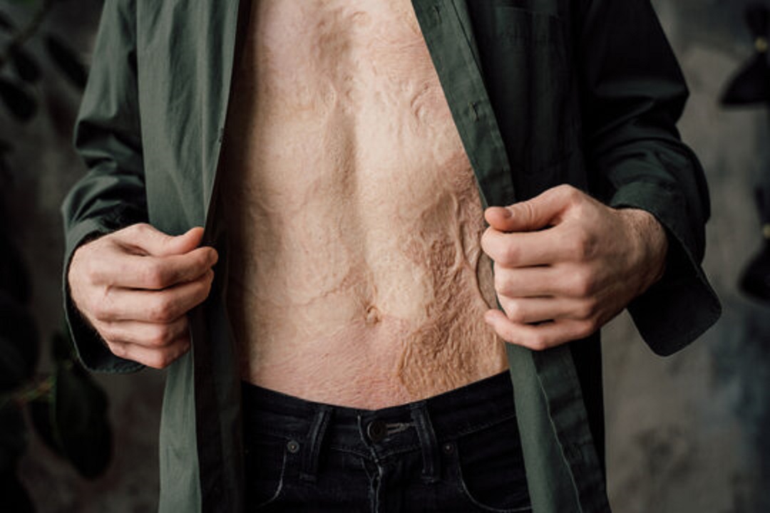 Long-term care after reconstructive burn surgery