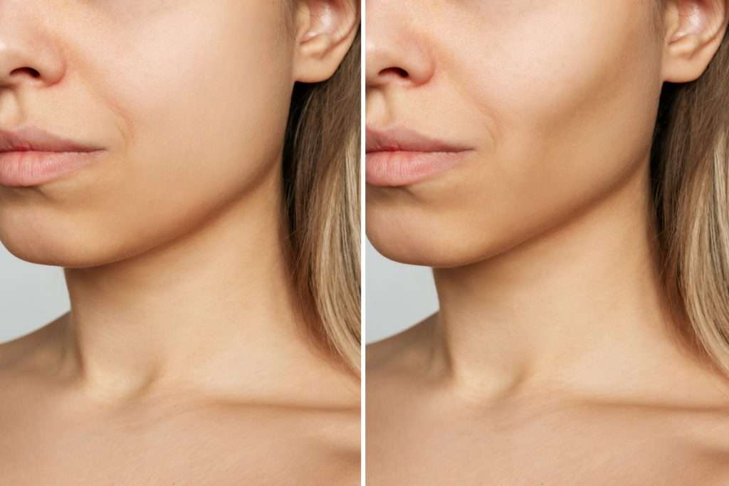 Cheek Augmentation for a Sculpted Facial Look