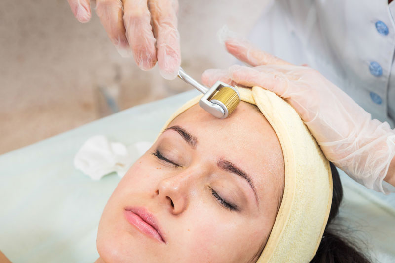 Micro-needling for acne scars: Success rate facts