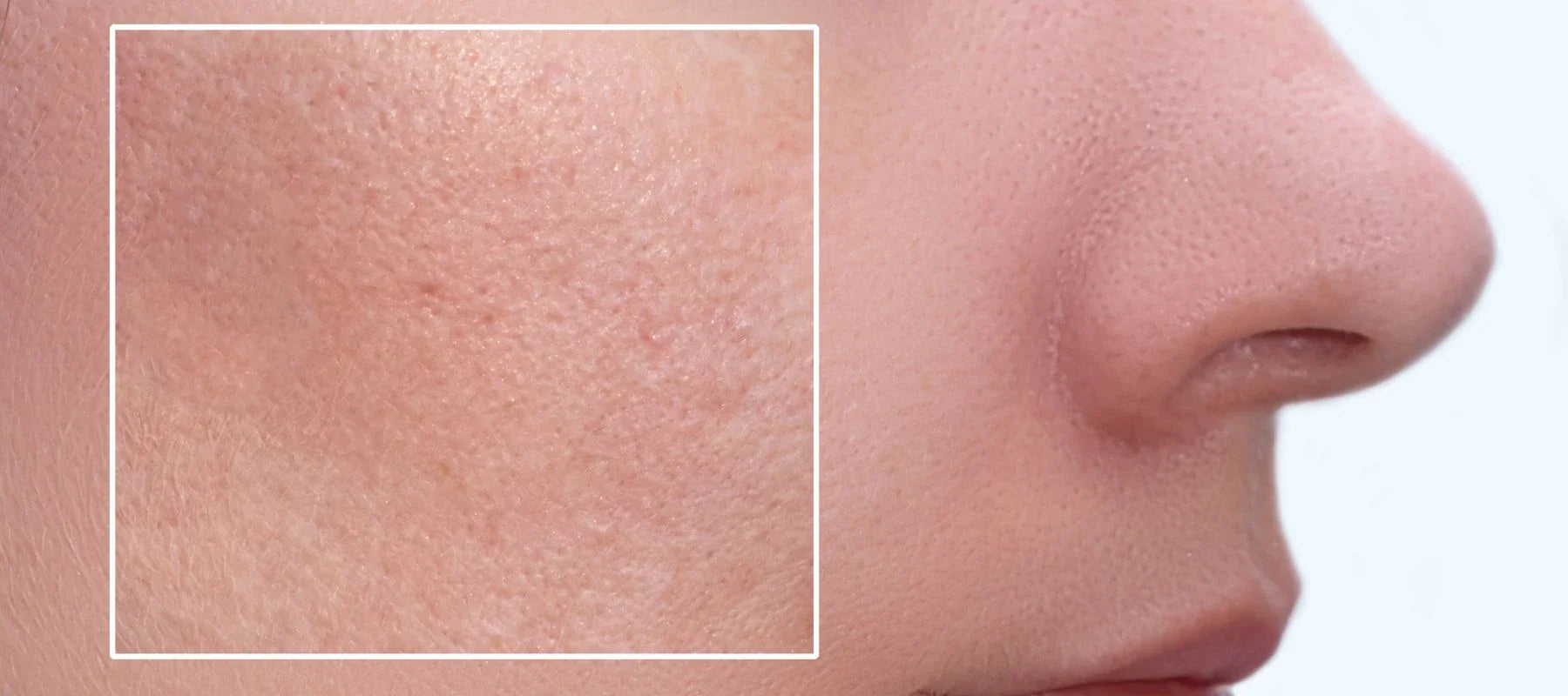 Best skincare routines for large pores treatment