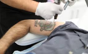 Laser Tattoo Removal: Say Goodbye to Regret