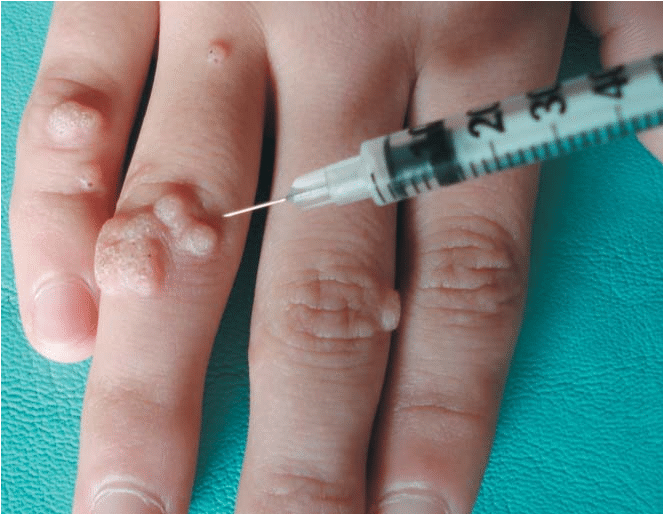 Long-Term Outcomes of Warts Removal Surgery