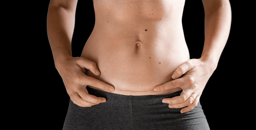 Real Change with 360 Liposuction Sculpting