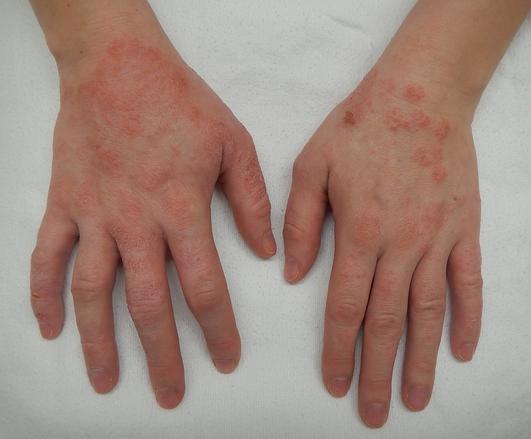 Can a dermatologist treat scalp eczema and clear scalp