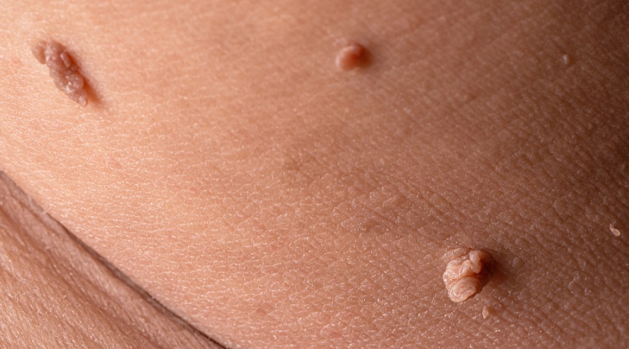How to Remove Skin Tags on the Inner Thigh: What’s Safe and What’