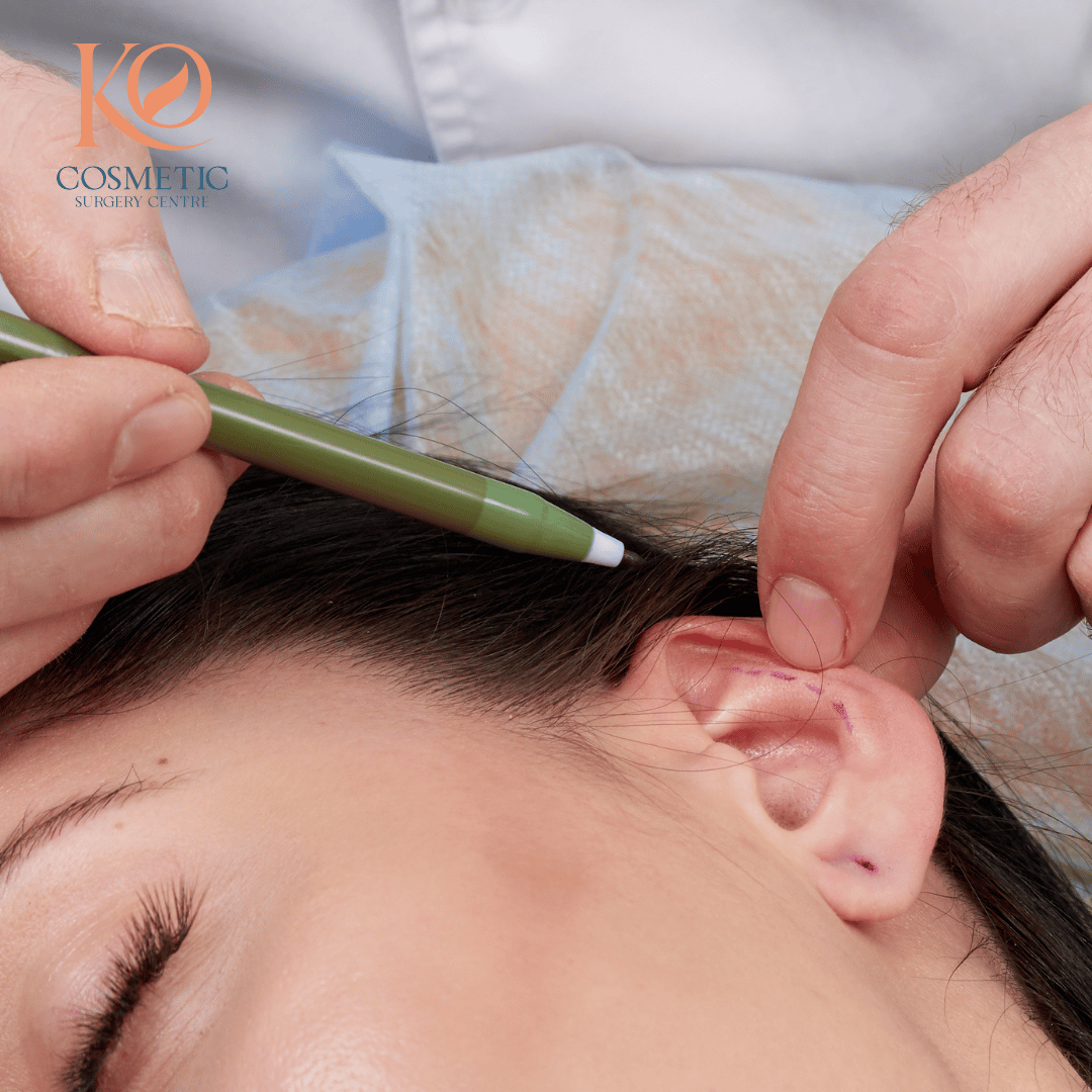Ear Reshaping: Achieve Balance and Symmetry with Confidence