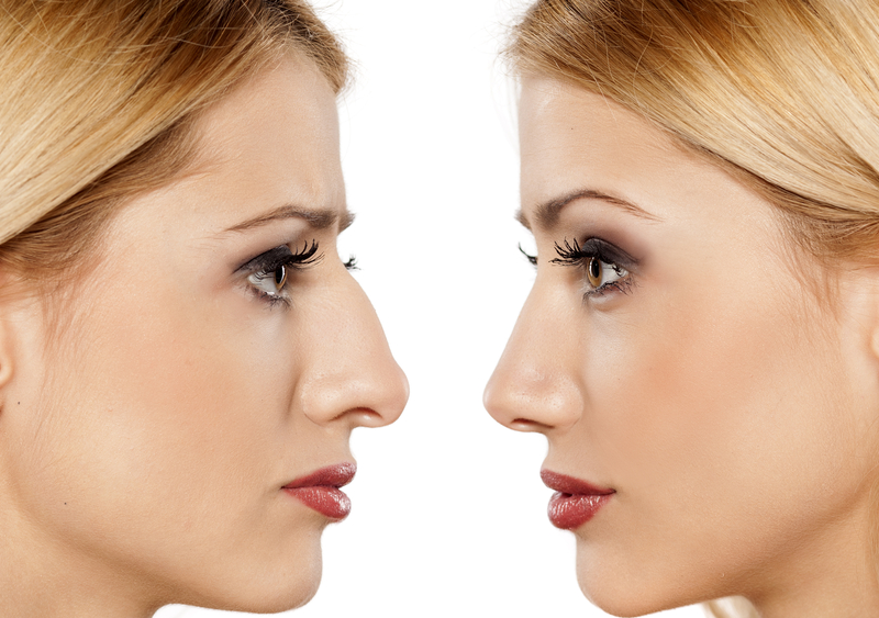 Achieve the Perfect Profile with Advanced Rhinoplasty