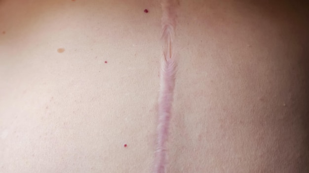 Surgical Scar Revision Safe Procedures for Scar-Free Skin