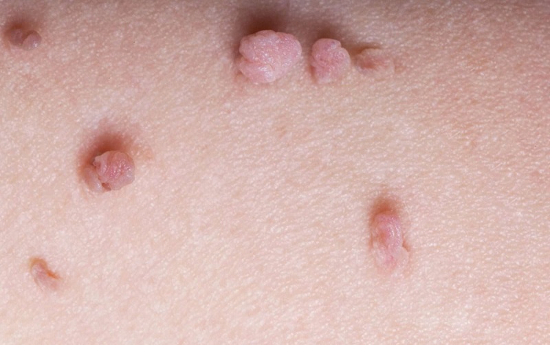 Safe and Reliable Treatment of Skin Tags Today