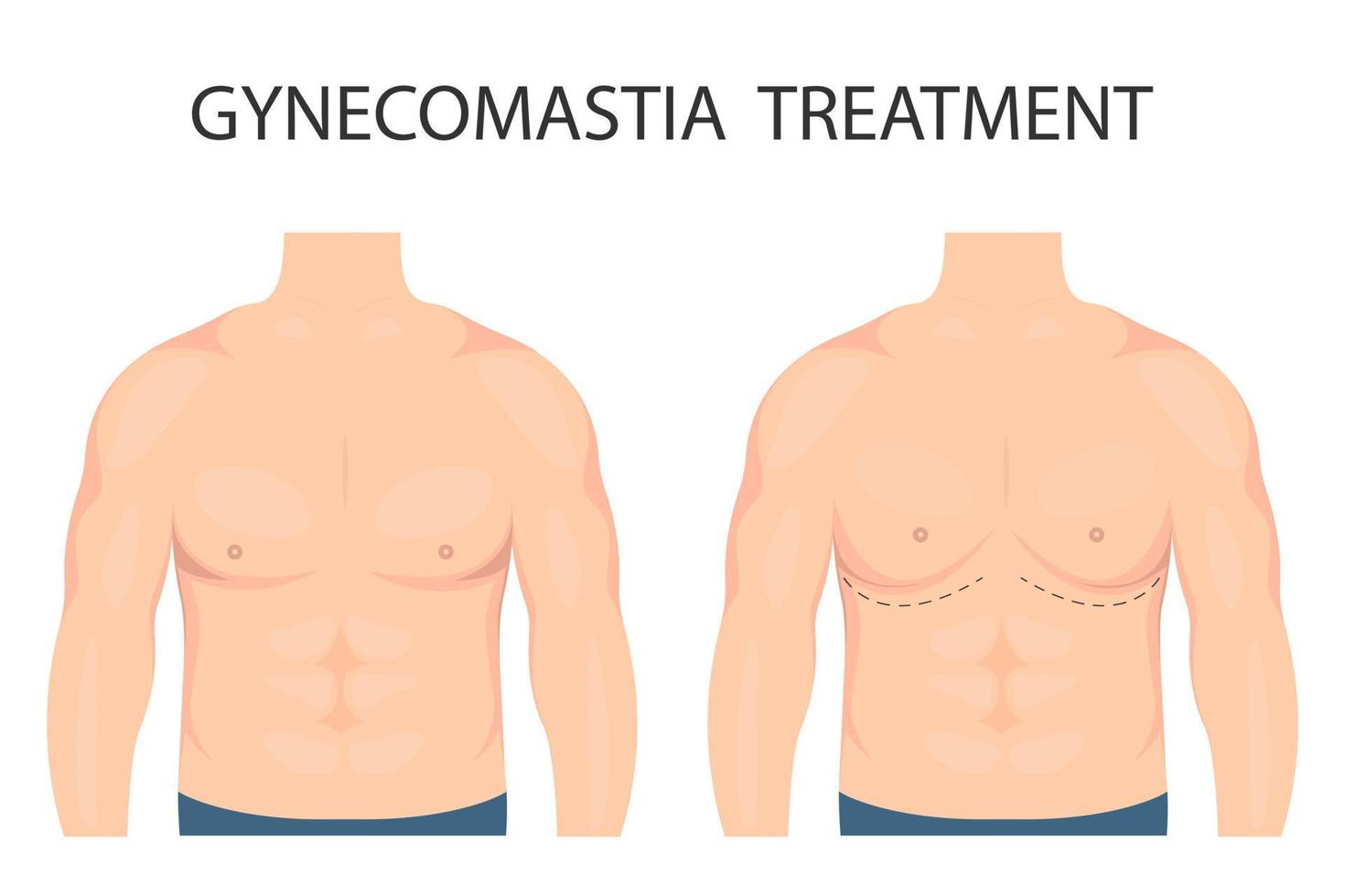 Gynecomastia Surgery in Islamabad