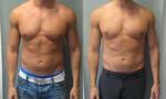 Gynecomastia - Reduce Man Boobs With Vaser Lipo Treatment