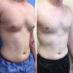 Gynecomastia - Your Questions Answered Gynecomastia - Your Questions Answered