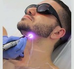 man beard laser hair removal