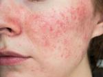 Actinic Keratosis Treatment