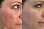 Cryosurgery – Cryotherapy in Dubai
