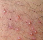 Incision and Drainage of Abscesses