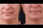 Exilis Treatment in Dubai
