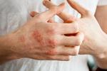 Skin Diseases treatment in Dubai