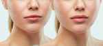 Pros & Cons of Lip Filler Injection
