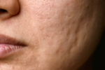 Acne Treatment in Dubai