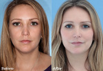Sculptra: Things You Need to Know About Sculptra