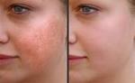 laser treatment in Pakistan