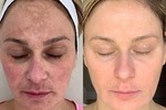 Cosmelan peels dubai