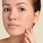 Pimples treatment in dubai and Abu Dhabi
