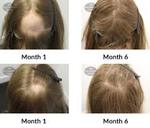 Alopecia Areata Treatmentin Pakistan