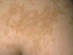 Birthmarks removal treatment in dubai