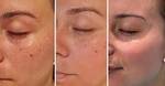 cosmelan peel in Dubai