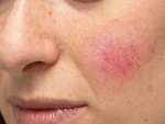 Rosacea treatment in dubai and Abu Dhabi