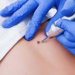 Warts removal in dubai and Abu Dhabi