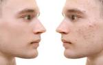 10 Unknown Myths about Acne Scars