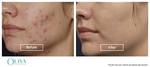 How Much Does Acne Scar Treatment Cost?