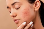 Reclaim Your Skin: Tried-And-True Pimple Treatments