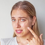 Pros And Cons of Pimple Treatment in Dubai