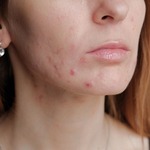 Pimples Treatment for the Face Dubai & Abu Dhabi
