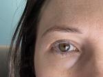 Hydra Facial For Dark Circle Treatment In Dubai