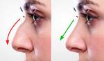 Septoplasty Surgery in Islamabad