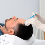 ACell PRP Therapy Hair Loss in Dubai