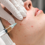 Pimples Treatment in Dubai and Abu Dhabi