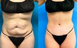Tummy Tuck