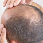 Stem Cell Hair Transplant 
