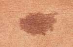 Birthmarks Removal Treatment In Dubai