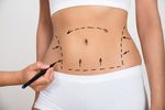 Liposuction Cost