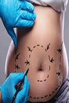 Tummy Tuck in Riyadh