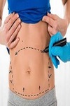 Liposuction surgery in Riyadh